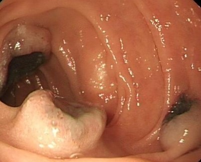 PET scan: πολλαπλές δευτεροπαθείς εναποθέσεις (Ευγενική παραχώρηση Dr. V. Penopoulos)