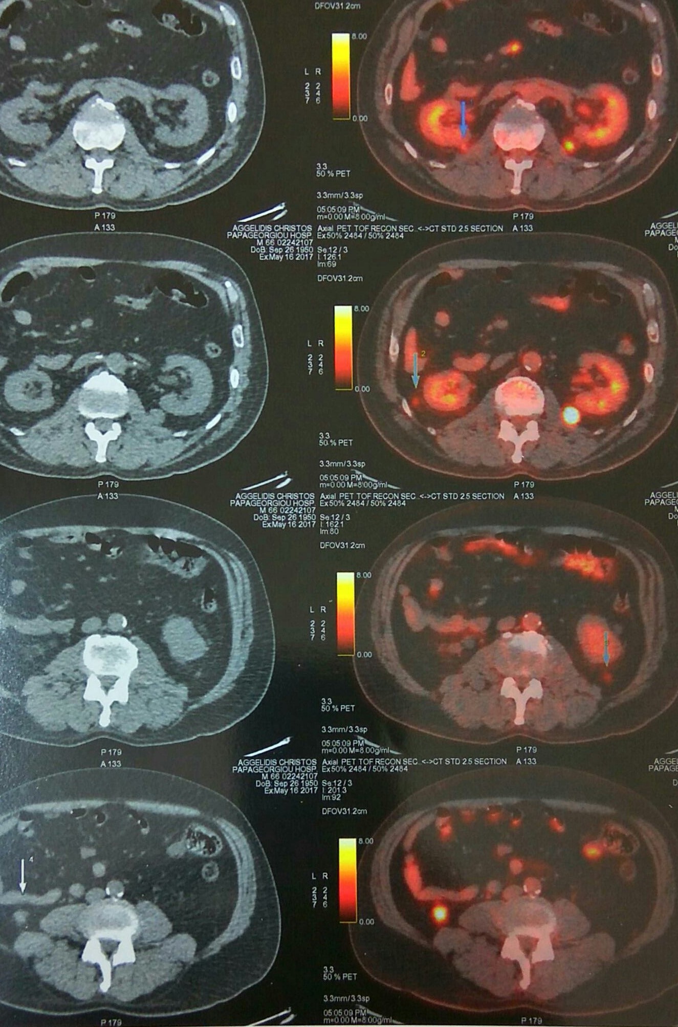 PET scan: πολλαπλές δευτεροπαθείς εναποθέσεις (Ευγενική παραχώρηση Dr. V. Penopoulos)