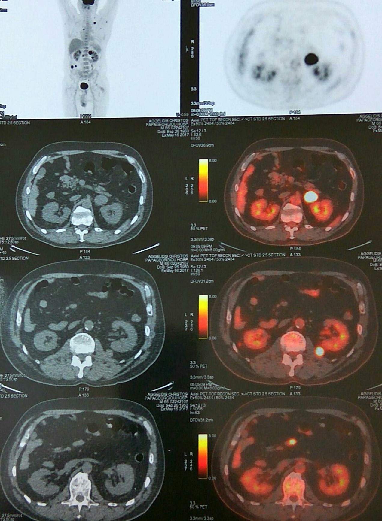 PET scan: πολλαπλές δευτεροπαθείς εναποθέσεις (Ευγενική παραχώρηση Dr. V. Penopoulos)