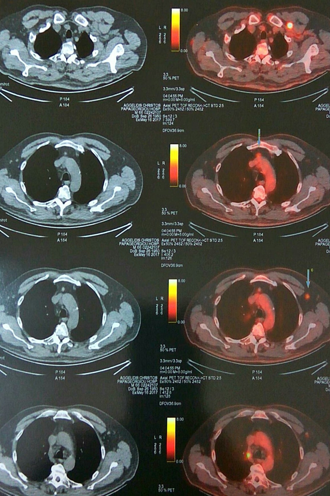 PET scan: πολλαπλές δευτεροπαθείς εναποθέσεις (Ευγενική παραχώρηση Dr. V. Penopoulos)