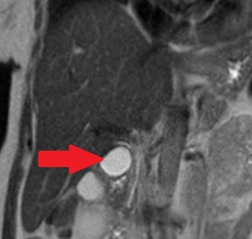 MRCP showing probably a type II choledochal cyst. ( Courtesy Dr . V . Penopoulos ) (Courtesy Dr. V. Penopoulos).