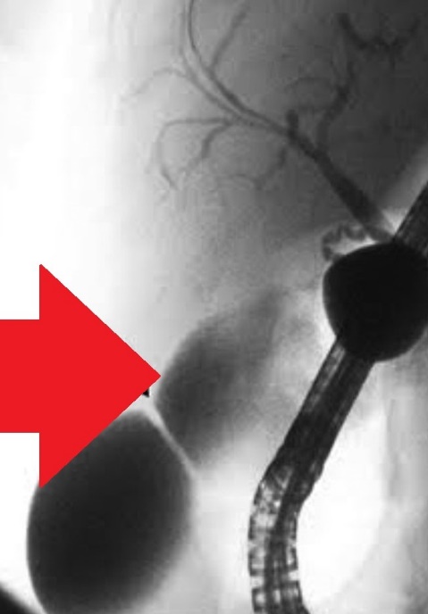ERCP image of gallbladder stricture. ( Courtesy Dr . V . Penopoulos ) (Courtesy Dr. V. Penopoulos).