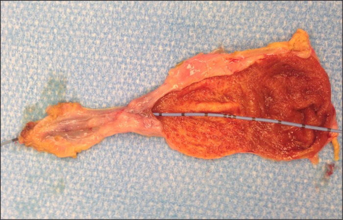 Gross image of the gallbladder stricture. ( Courtesy Dr . V . Penopoulos ) (Courtesy Dr. V. Penopoulos).
