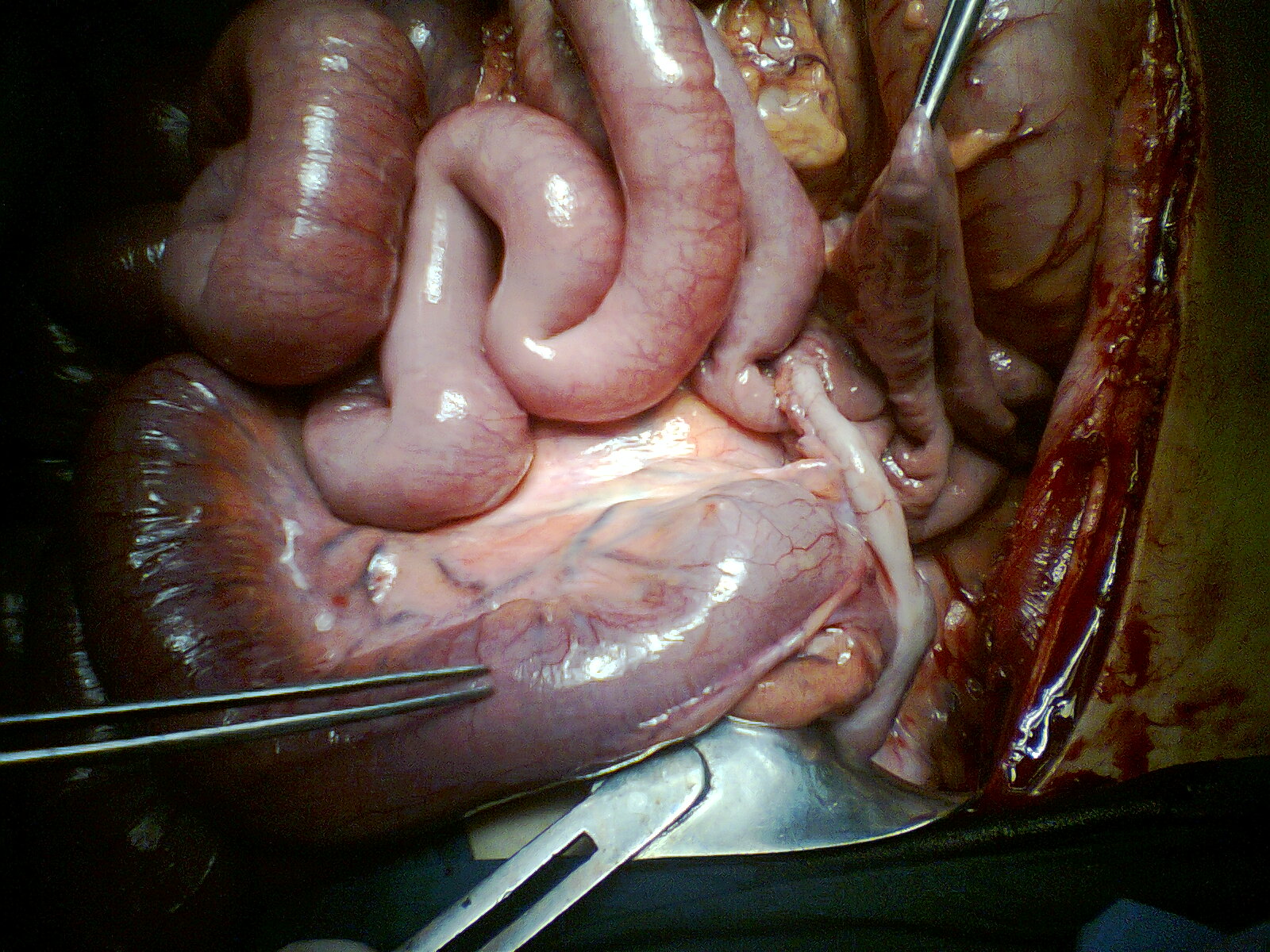 Παρασκεύασμα δεξιάς ημικολεκτομής. Το ενσφηνωμένο βλεννοκοπρανώδες υλικό στον τελικό ειλεό είναι εμφανώς ορατό (Ευγενική παραχώρηση Dr. V. Penopoulos)