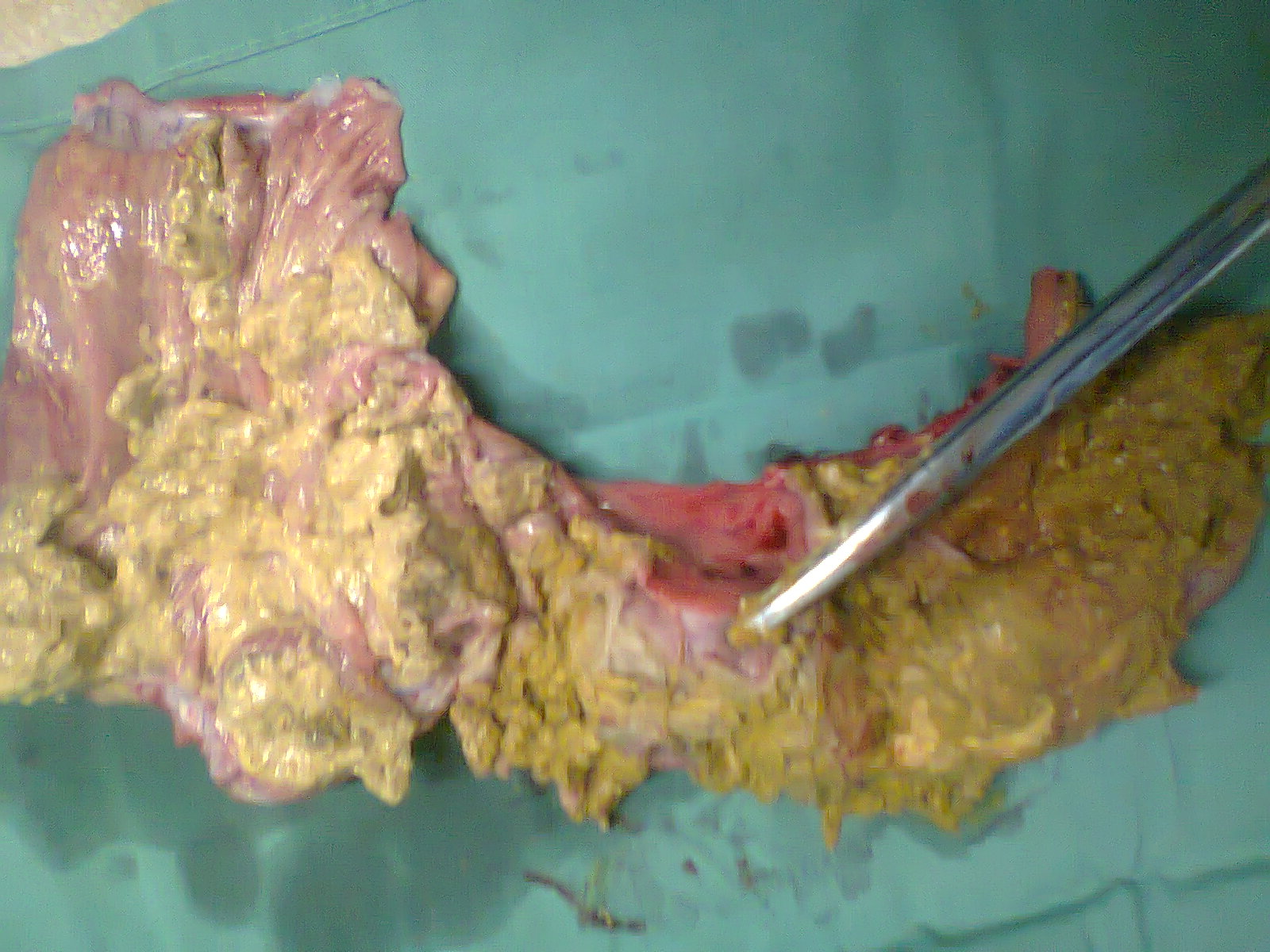 Παρασκεύασμα δεξιάς ημικολεκτομής. Το ενσφηνωμένο βλεννοκοπρανώδες υλικό στον τελικό ειλεό είναι εμφανώς ορατό (Ευγενική παραχώρηση Dr. V. Penopoulos)