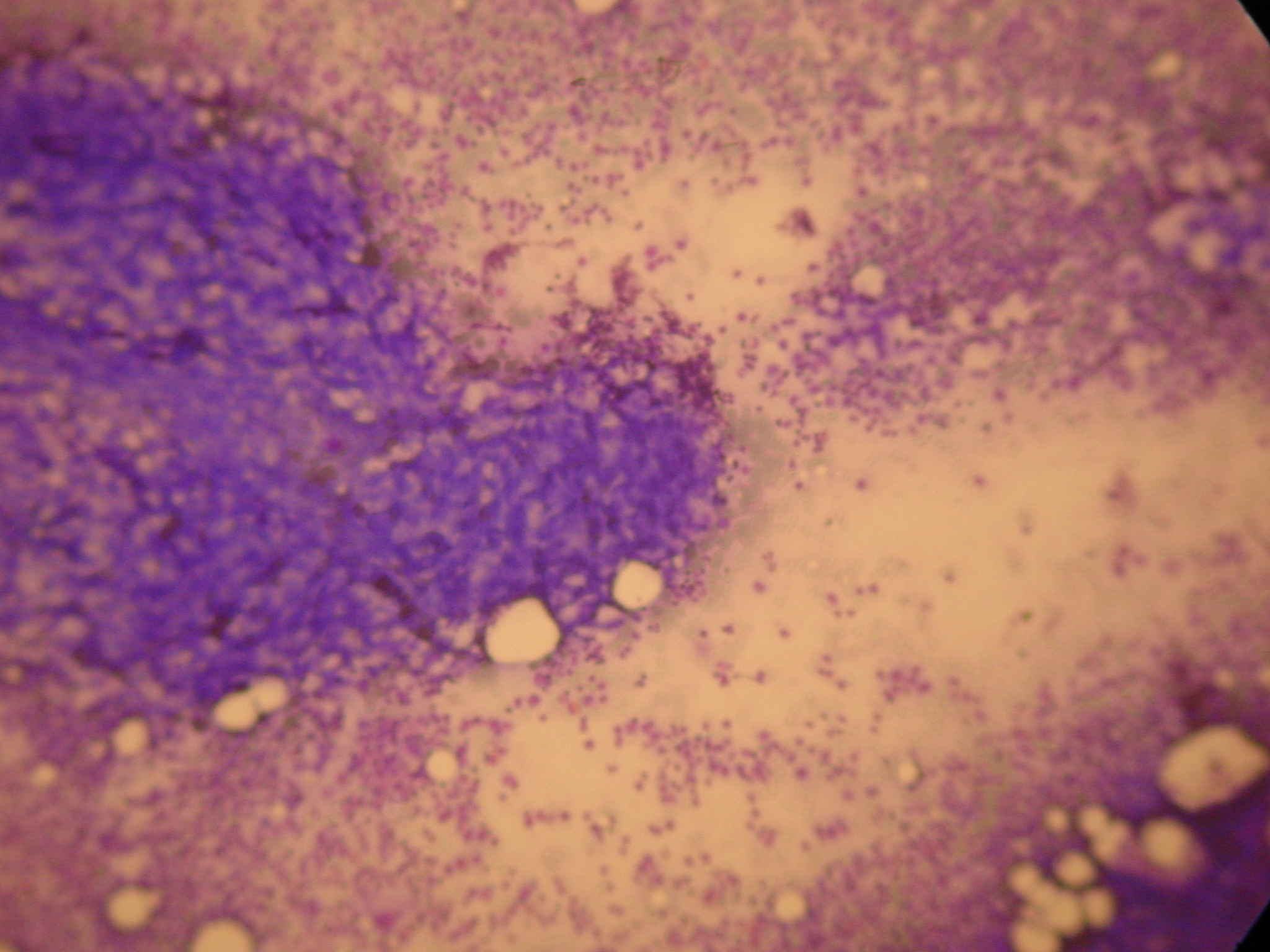 Διάχυτη καρκινωμάτωση μυελού των οστών (Ευγενική παραχώρηση Dr. V. Penopoulos)