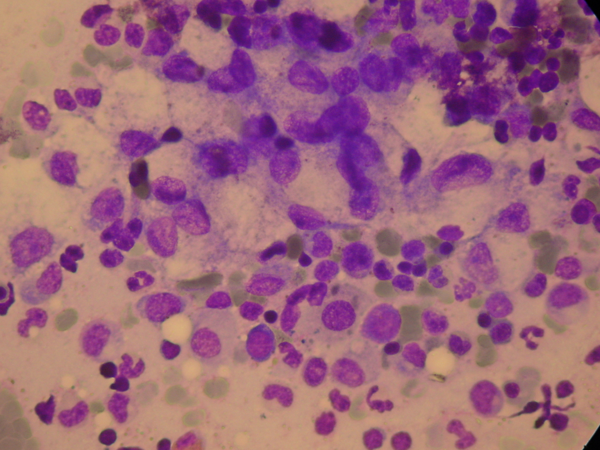 Διάχυτη καρκινωμάτωση μυελού των οστών (Ευγενική παραχώρηση Dr. V. Penopoulos)