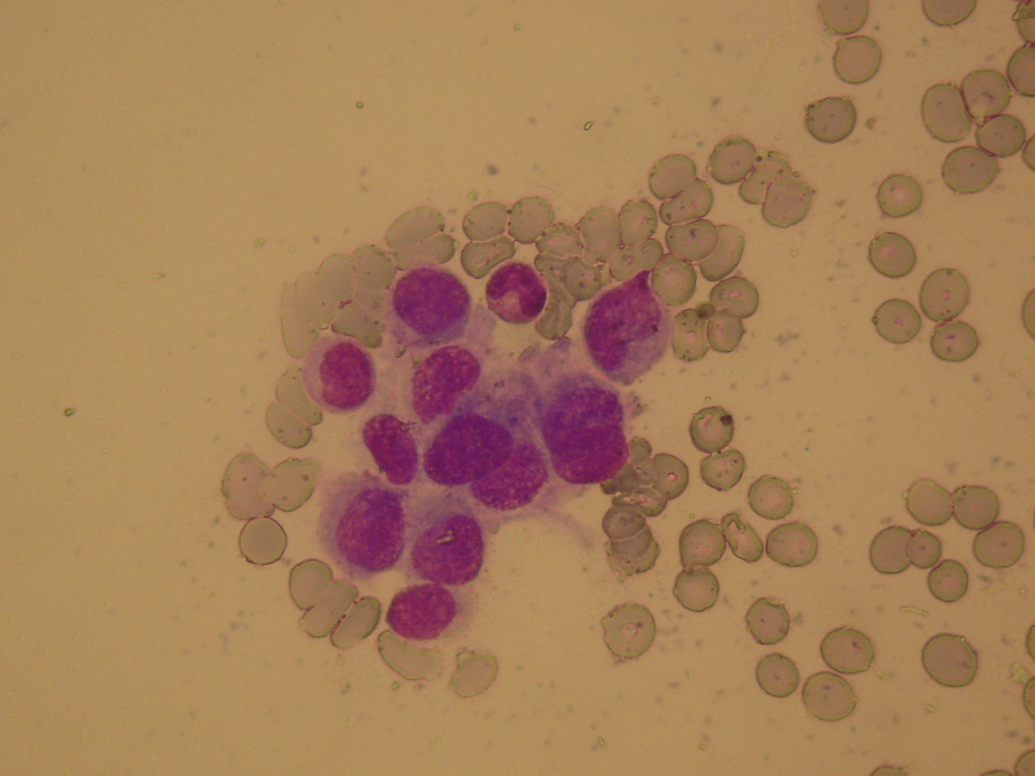 Διάχυτη καρκινωμάτωση μυελού των οστών (Ευγενική παραχώρηση Dr. V. Penopoulos)