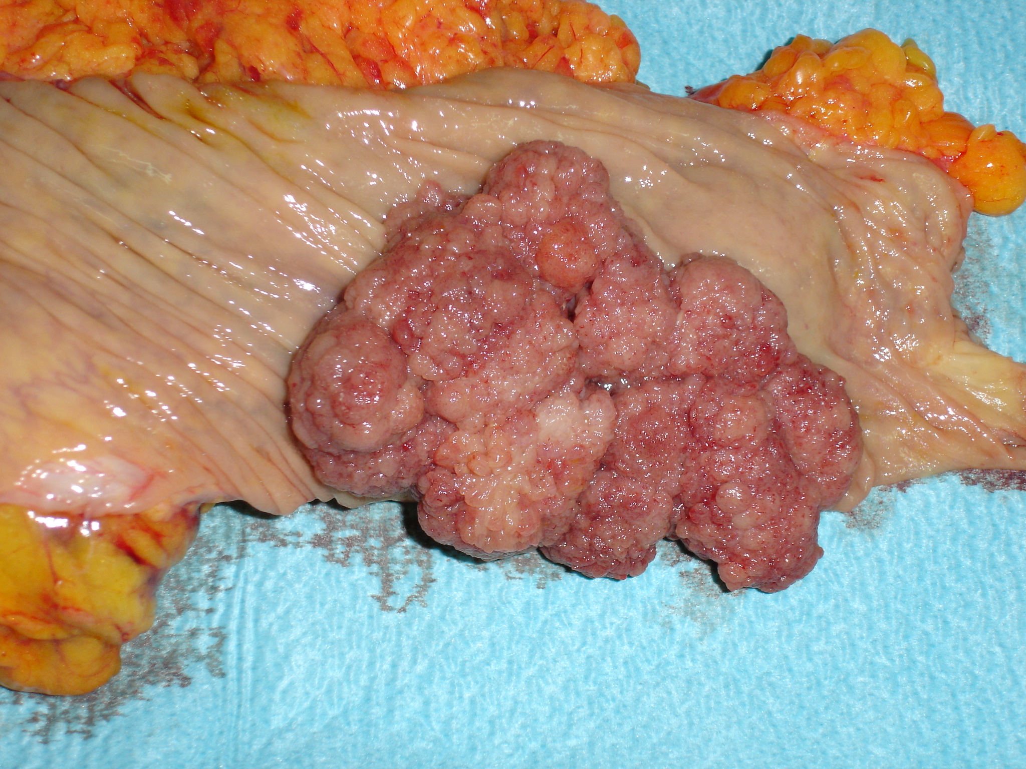 Διάχυτη καρκινωμάτωση μυελού των οστών (Ευγενική παραχώρηση Dr. V. Penopoulos)