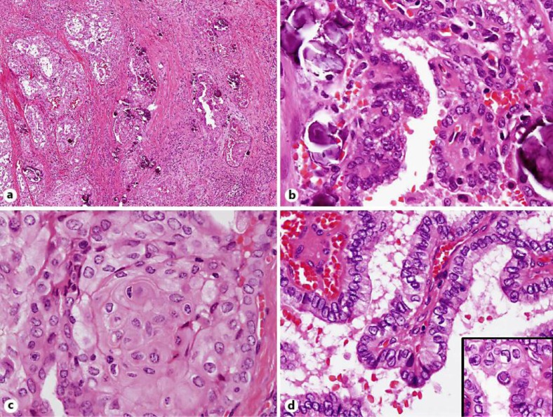 A growing papillary tumor with remarkable fibrosis and lymphocytic infiltration is clearly seen (Courtesy Dr. V. Penopoulos)