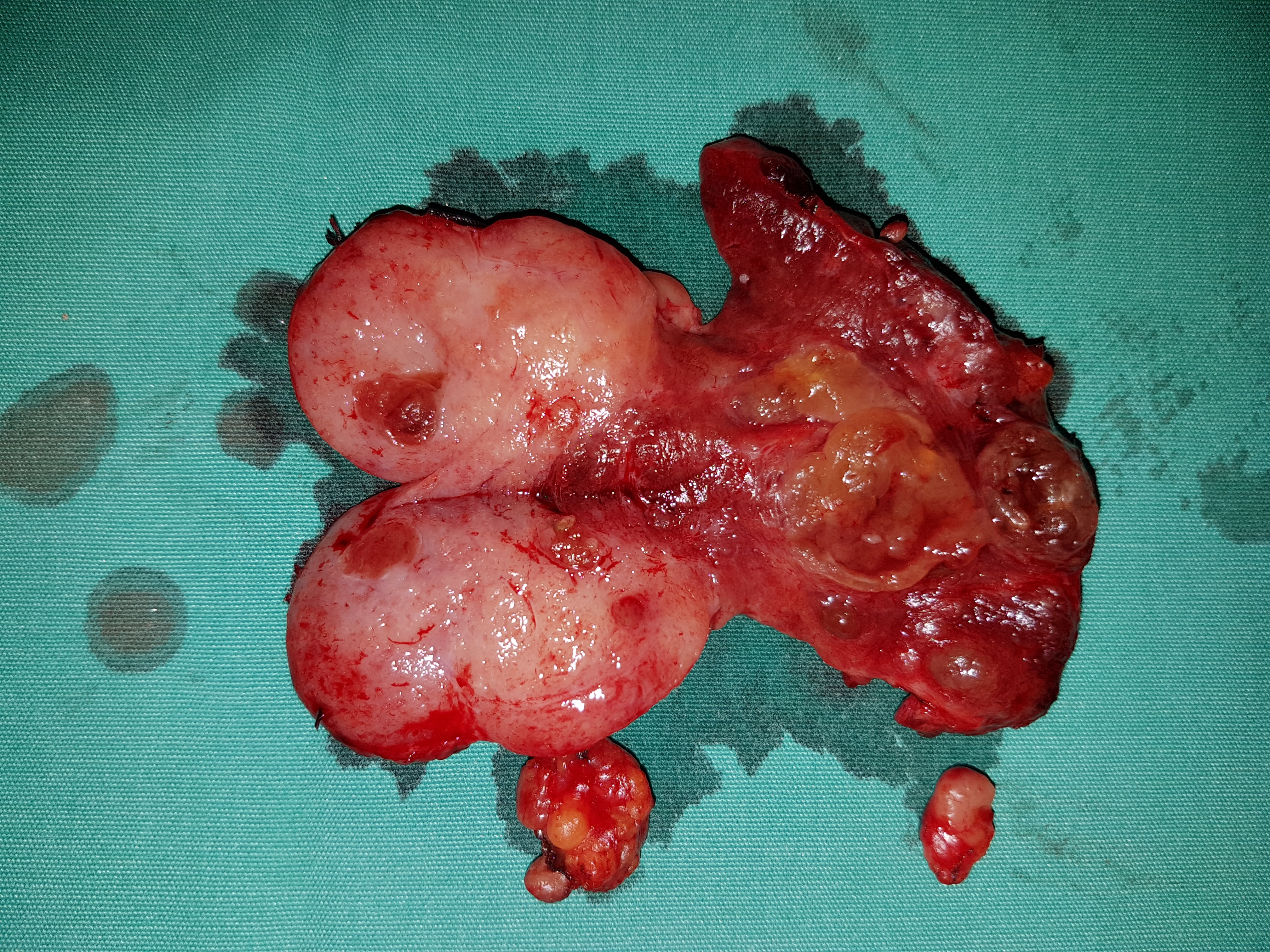 The diffuse sclerosing papillary carcinoma of the right lobe is evident . Two groups of infiltrated lymph nodes are also seen (Courtesy Dr. V. Penopoulos)