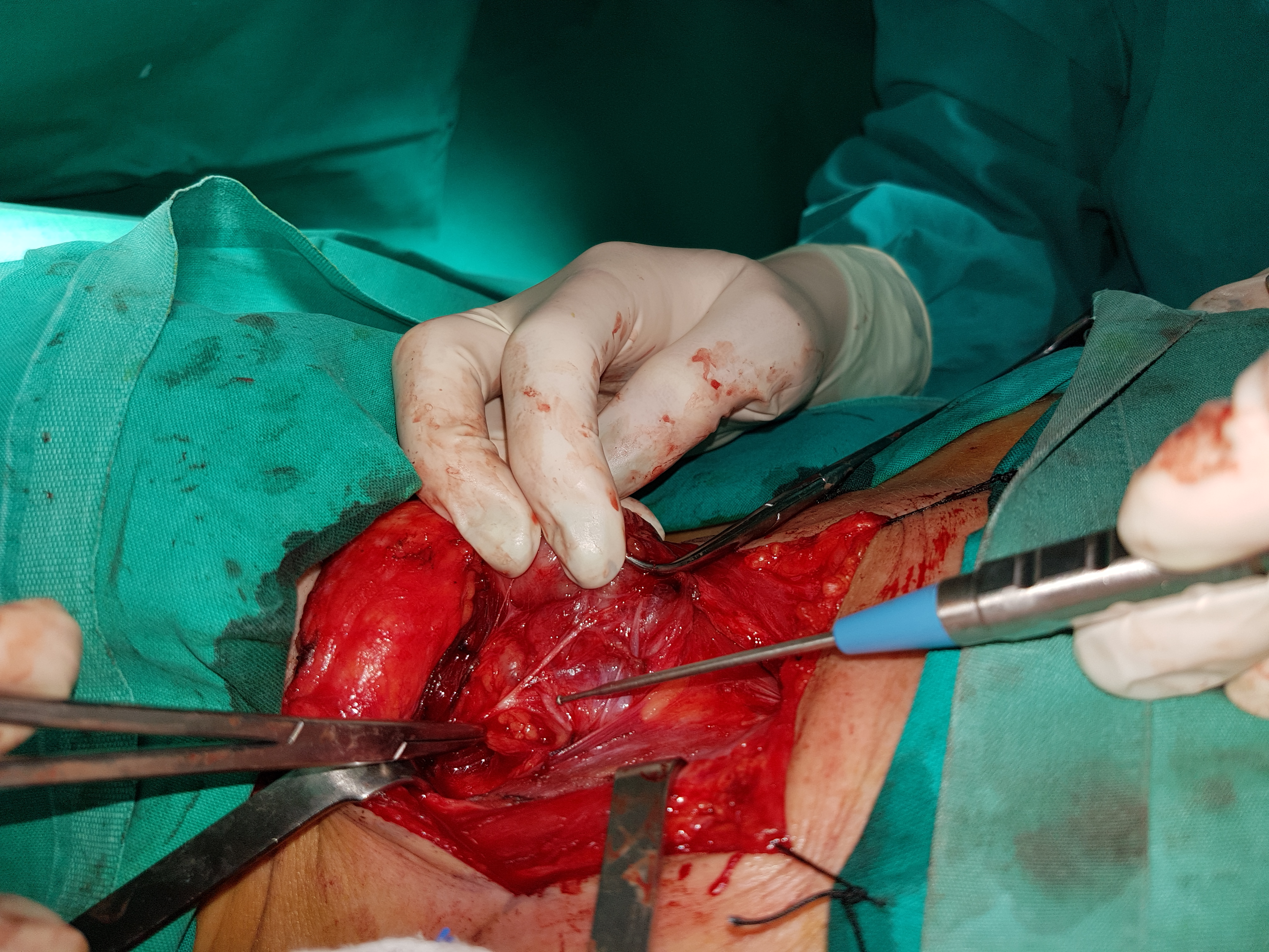 The right inferior laryngeal nerve was densely adherent to the papillary tumor (Courtesy Dr. V. Penopoulos)