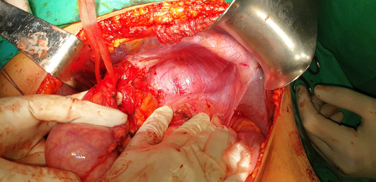 Φυσιολογική ακτινογραφία θώρακος δύο μήνες μετά την επέμβαση (Ευγενική παραχώρηση Dr. V. Penopoulos)