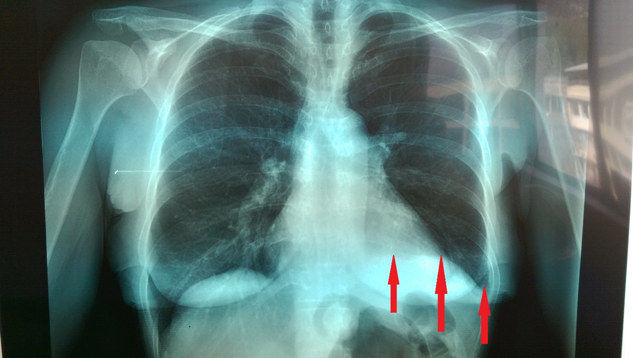 Φυσιολογική ακτινογραφία θώρακος δύο μήνες μετά την επέμβαση (Ευγενική παραχώρηση Dr. V. Penopoulos)