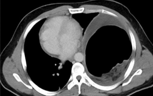 Φυσιολογική ακτινογραφία θώρακος δύο μήνες μετά την επέμβαση (Ευγενική παραχώρηση Dr. V. Penopoulos)