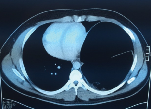 Ακτινογραφία θώρακος μετά από πλύχυνση του αριστερού διαφράγματος. Η πλήρης έκπτυξη του αριστερού πνεύμονα είναι εμφανής. Το αριστερό διάφραγμα πλέον φαίνεται ισιωμένο σε φυσιολογική θέση (Ευγενική παραχώρηση Dr. V. Penopoulos)