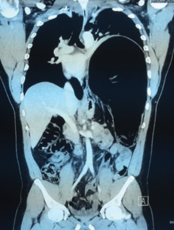 Φυσιολογική ακτινογραφία θώρακος δύο μήνες μετά την επέμβαση (Ευγενική παραχώρηση Dr. V. Penopoulos)