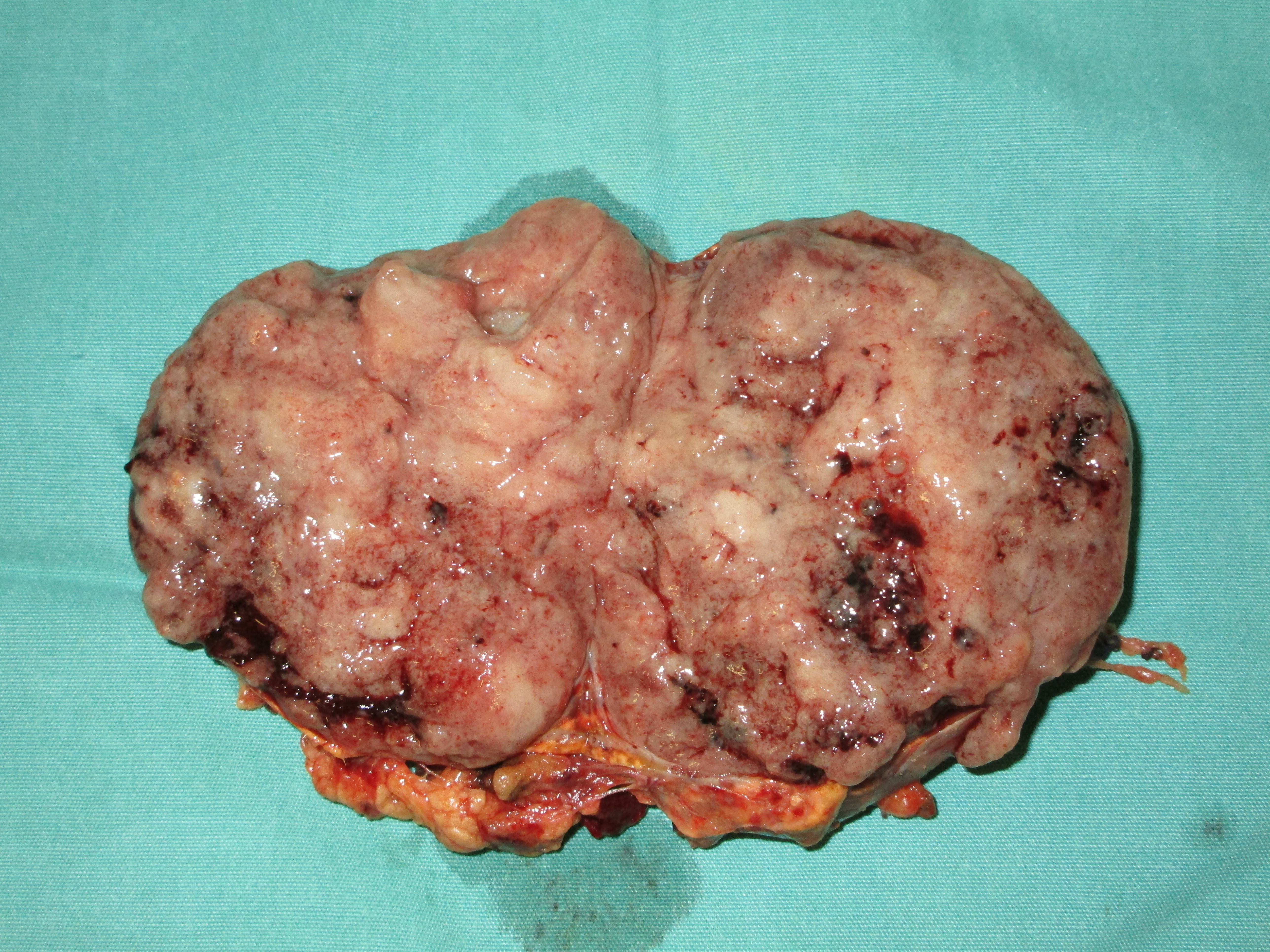 Typical non cystic phaeochromocytoma (Courtesy Dr. V. Penopoulos)