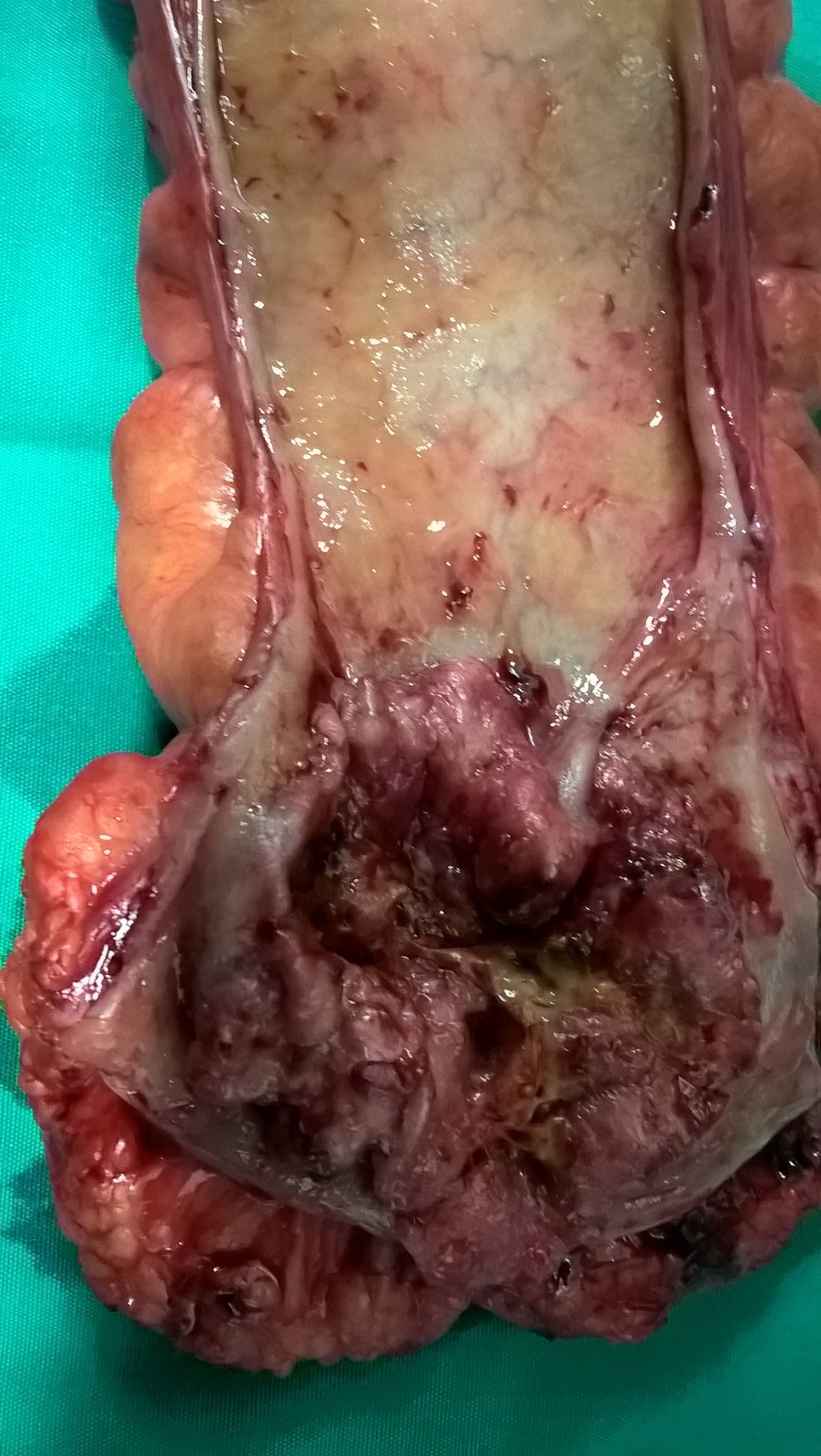 Το αφαιρεθέν αδενοκαρκίνωμα ορθού (Ευγενική παραχώρηση Dr. V. Penopoulos).