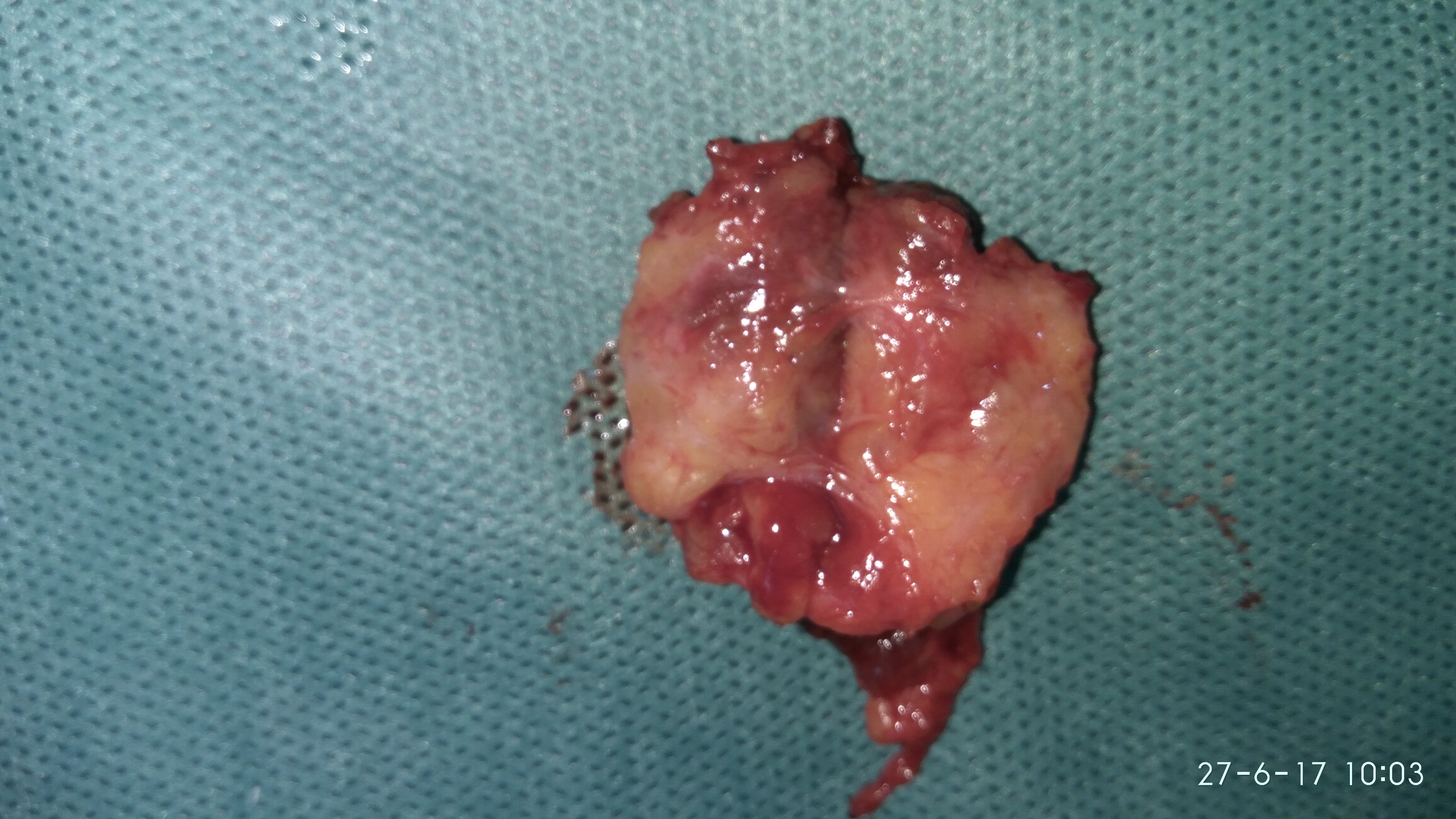 Wound nicely healed following excision (Courtesy Dr. V. Penopoulos)