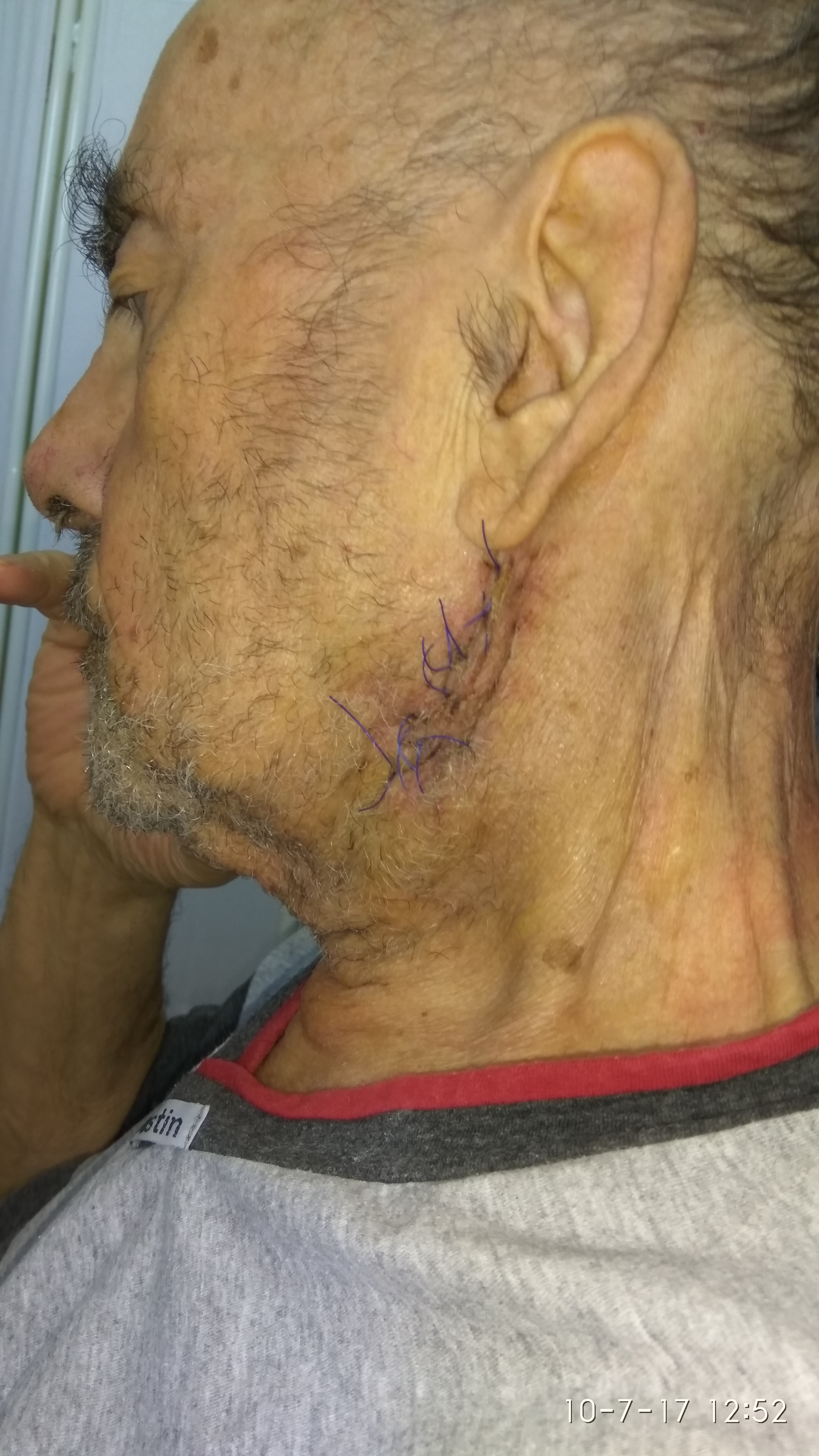 Wound nicely healed following excision (Courtesy Dr. V. Penopoulos)