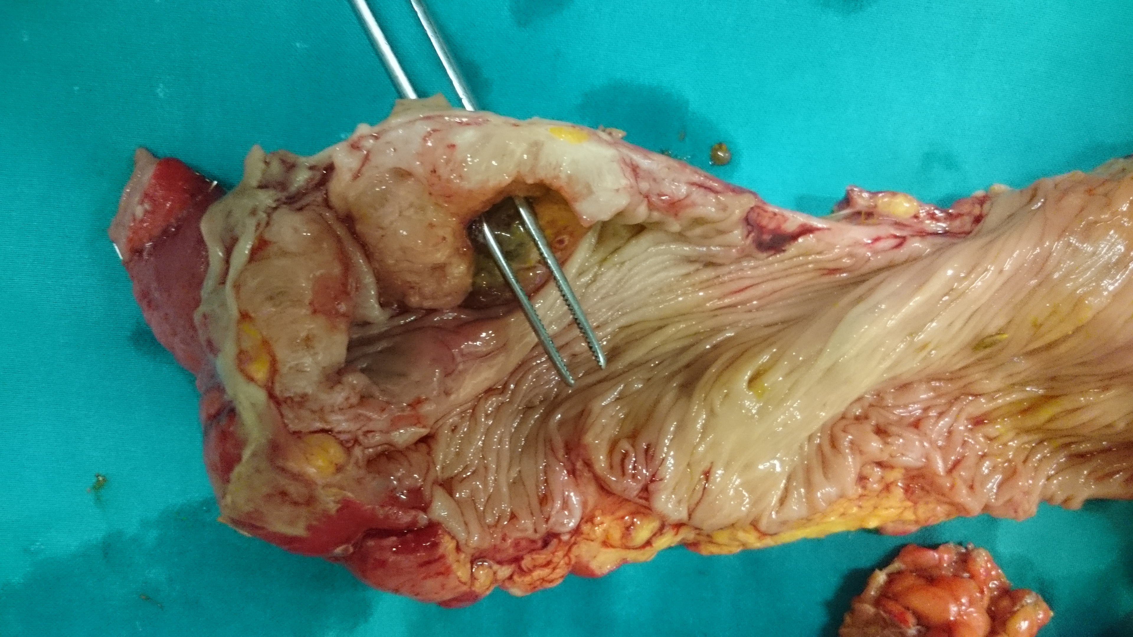 Διάτρηση του τυφλού δευτεροπαθής σε συνυπάρχουσα στένωση-απόφραξη κατιόντος σιγμοειδούς κόλου (Ευγενική παραχώρηση Dr. V. Penopoulos)
