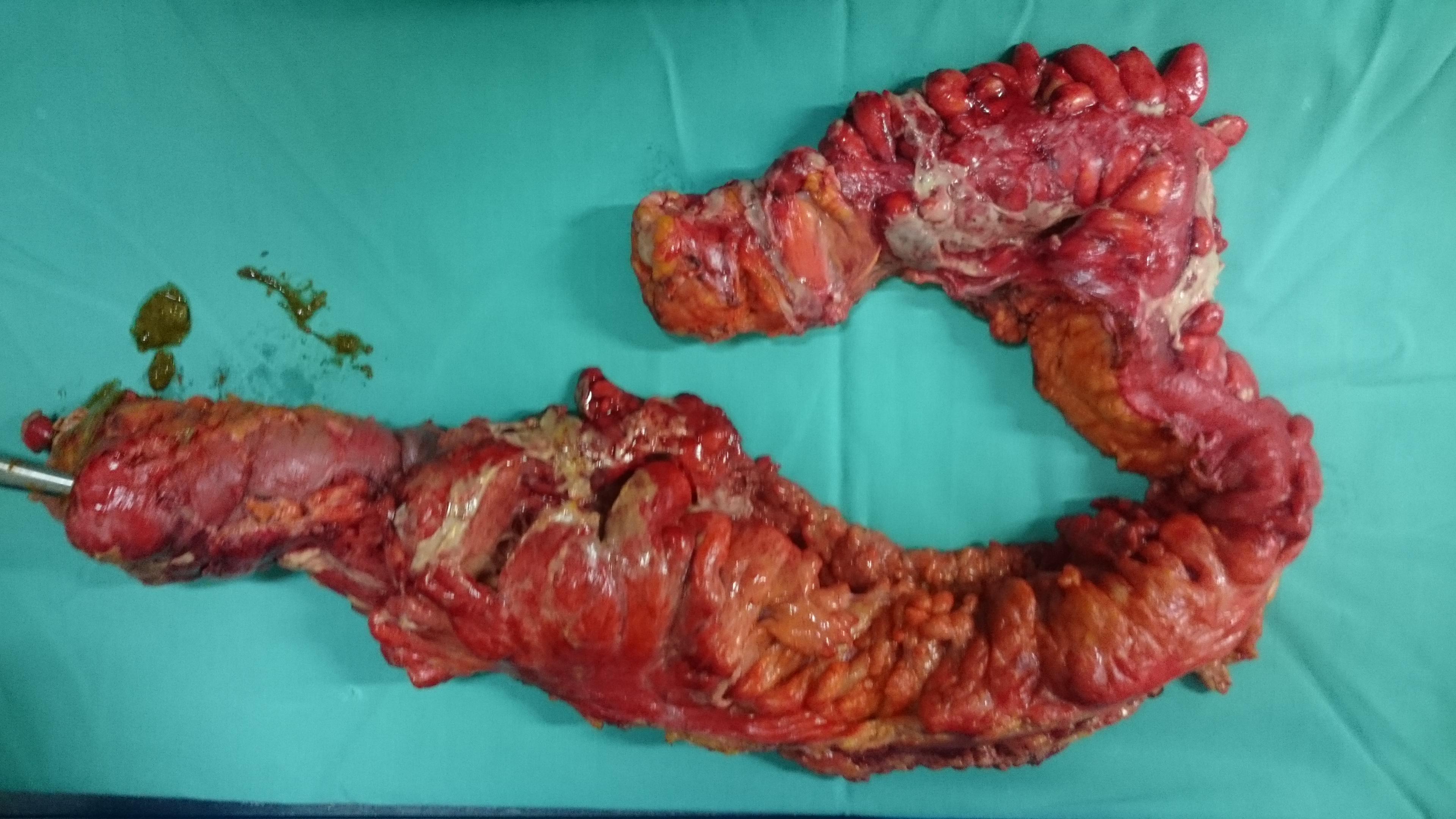 Ακραία φλεγμονή του αριστερού ημικολικού δευτεροπαθώς σε εκκολπωματίτιδα και καλυμμένες διατρήσεις (Ευγενική παραχώρηση Dr. V. Penopoulos)