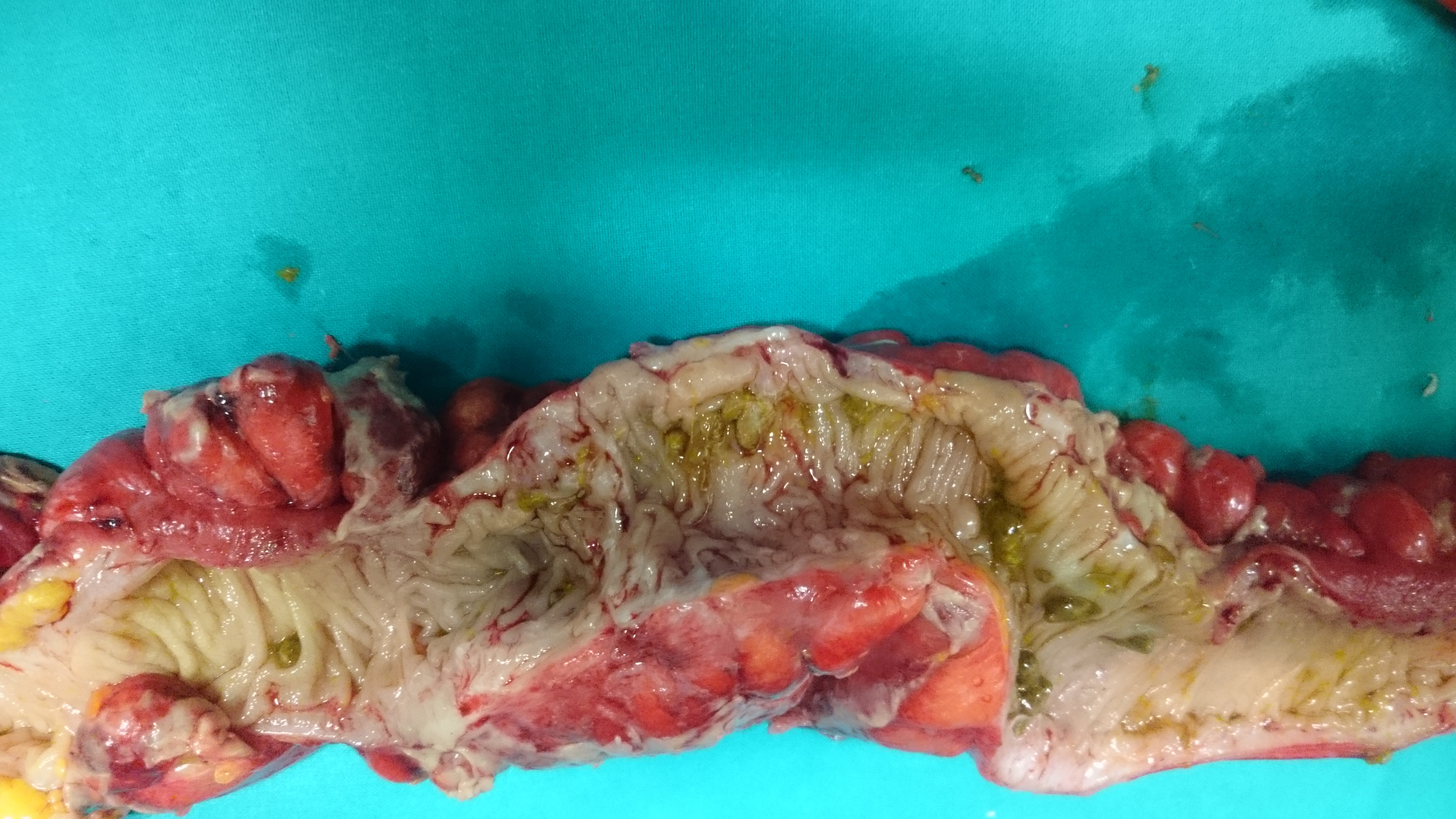 Ακραία φλεγμονή του αριστερού ημικολικού δευτεροπαθώς σε εκκολπωματίτιδα και καλυμμένες διατρήσεις (Ευγενική παραχώρηση Dr. V. Penopoulos)