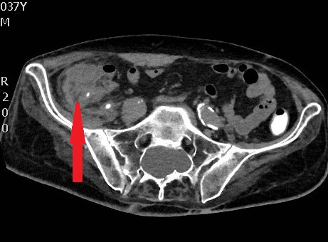Φωτομικρογραφία ιστολογικής τομής χρωματισμένης με αιματοξυλίνη και ηωσίνη που αποκαλύπτει τα νευροενδοκρινικά κύτταρα του όγκου (Ευγενική παραχώρηση Dr. V. Penopoulos)