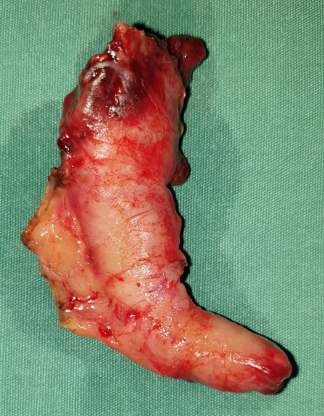 Φωτομικρογραφία ιστολογικής τομής χρωματισμένης με αιματοξυλίνη και ηωσίνη που αποκαλύπτει τα νευροενδοκρινικά κύτταρα του όγκου (Ευγενική παραχώρηση Dr. V. Penopoulos)