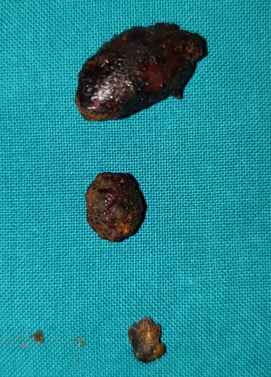 Φωτομικρογραφία ιστολογικής τομής χρωματισμένης με αιματοξυλίνη και ηωσίνη που αποκαλύπτει τα νευροενδοκρινικά κύτταρα του όγκου (Ευγενική παραχώρηση Dr. V. Penopoulos)