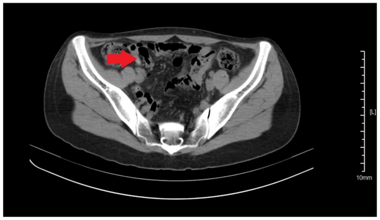 Καρκινοειδής σκωληκοειδούς (Ευγενική παραχώρηση Dr. V. Penopoulos)
