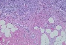 Φωτομικρογραφία ιστολογικής τομής χρωματισμένης με αιματοξυλίνη και ηωσίνη που αποκαλύπτει τα νευροενδοκρινικά κύτταρα του όγκου (Ευγενική παραχώρηση Dr. V. Penopoulos)