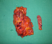 Παρασκευάσματα δεξιάς ημικολεκτομής και χολοκυστεκτομής (Ευγενική παραχώρηση Dr. V. Penopoulos)