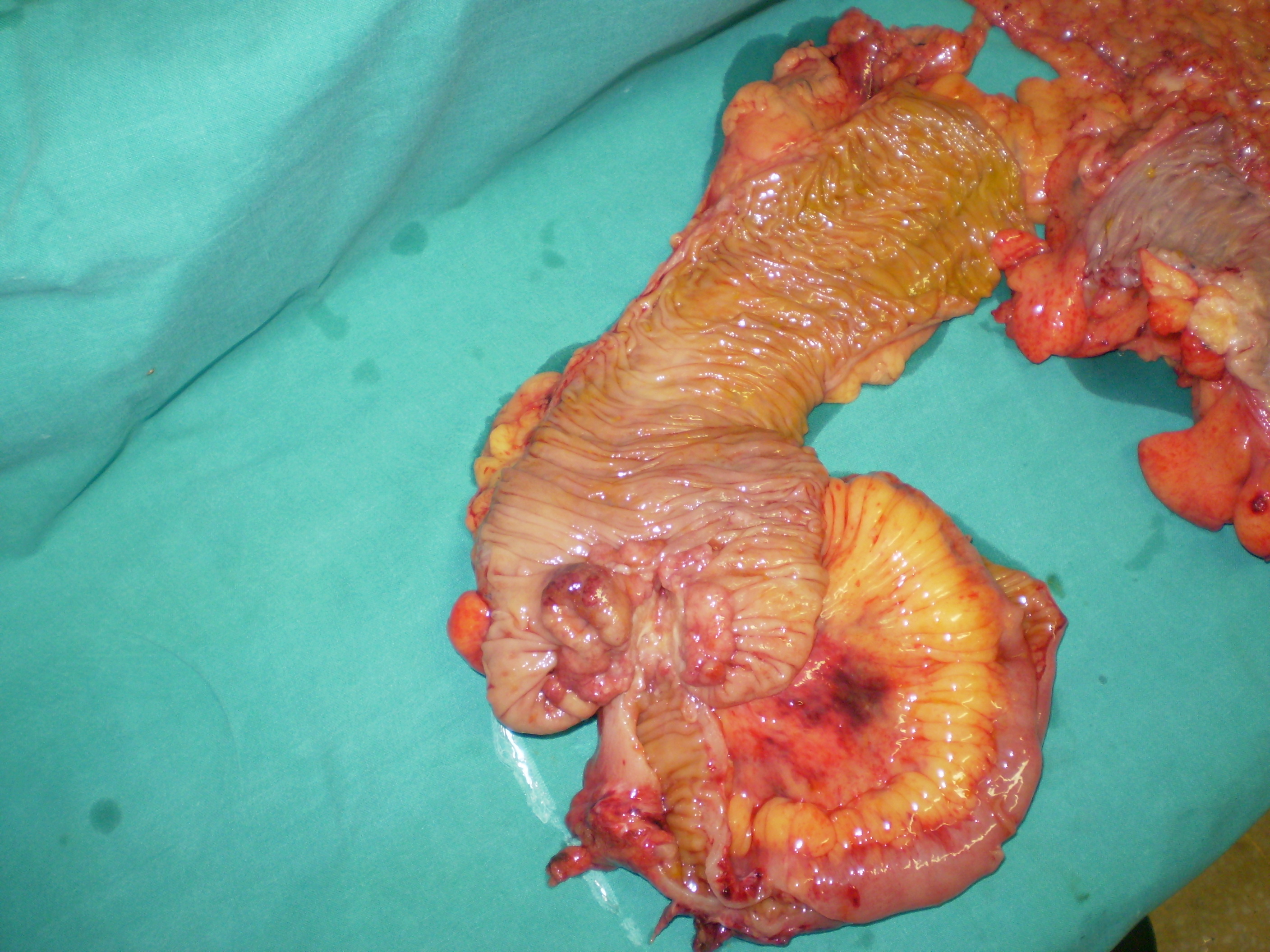 Χειρουργικό παρασκεύασμα (Ευγενική παραχώρηση Dr. V. Penopoulos)