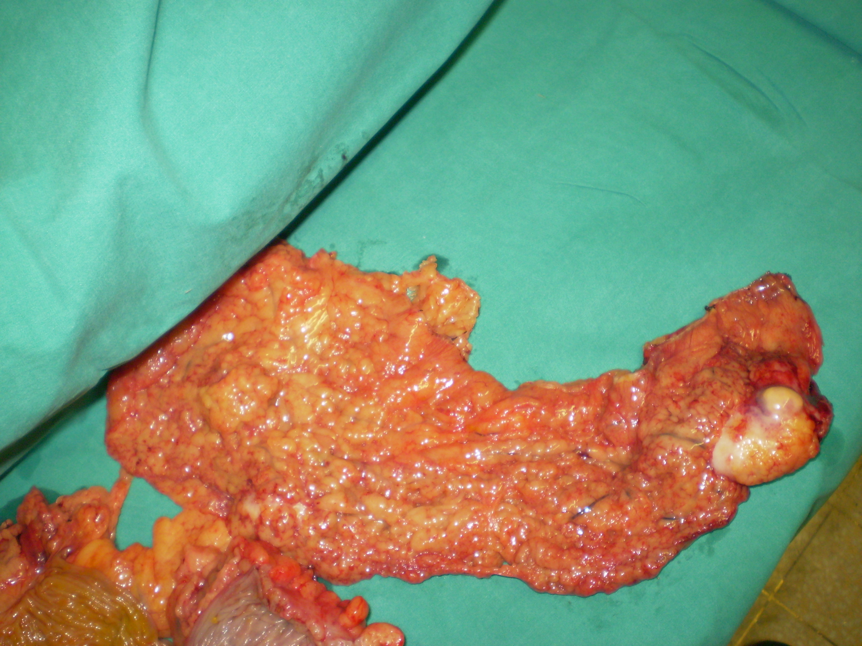 Χειρουργικό παρασκεύασμα (Ευγενική παραχώρηση Dr. V. Penopoulos)