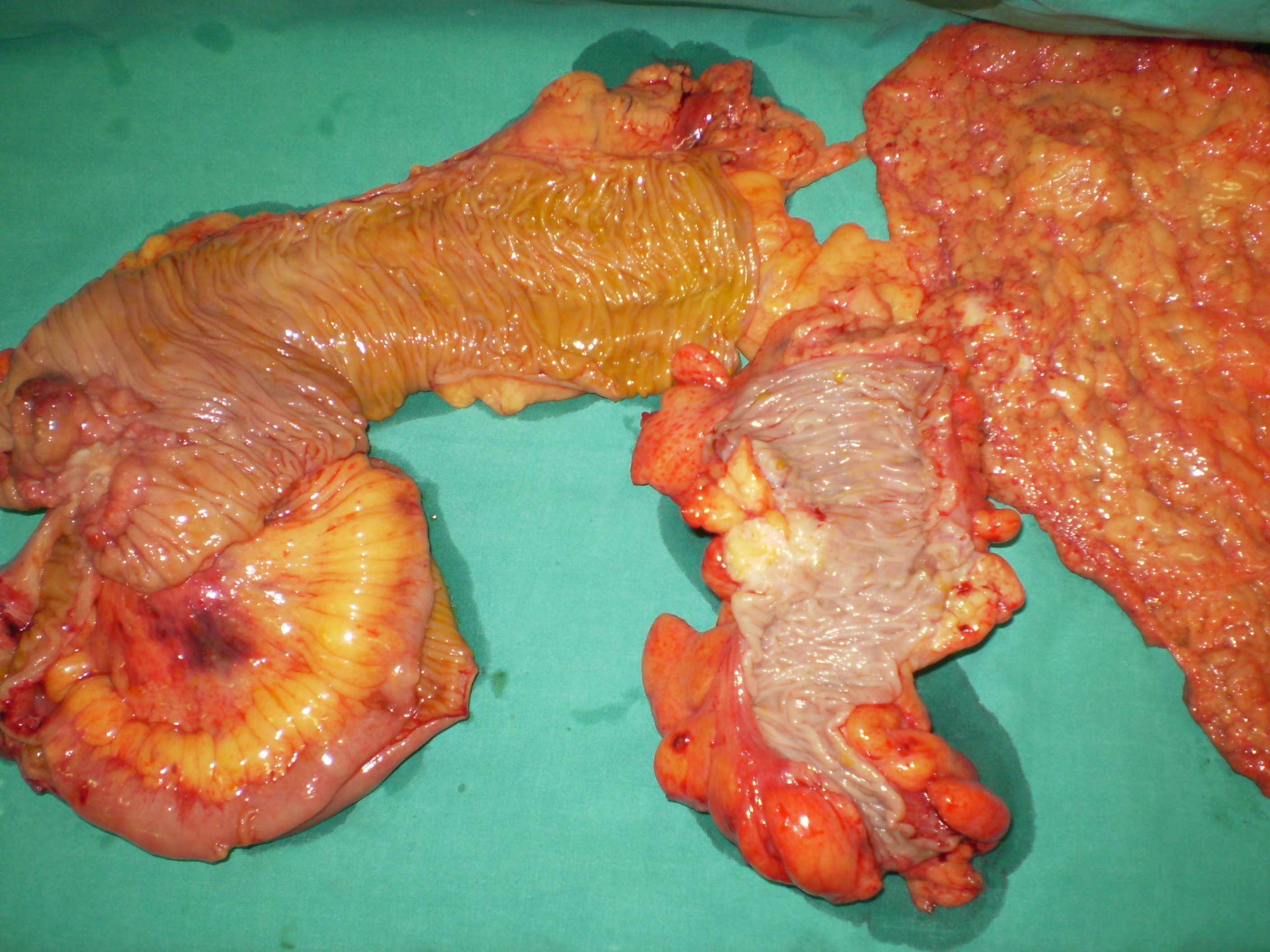 Χειρουργικό παρασκεύασμα (Ευγενική παραχώρηση Dr. V. Penopoulos)