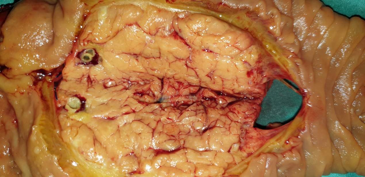 .Urine microscopy showing the presence of muddy brown granular casts with bile staining (Courtesy Dr. V. Penopoulos)