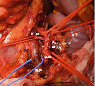 Specimen ( pancreatic head ) following modified Whipple’s operation (Courtesy Dr. V. Penopoulos)