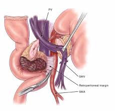 Specimen ( pancreatic head ) following modified Whipple’s operation (Courtesy Dr. V. Penopoulos)