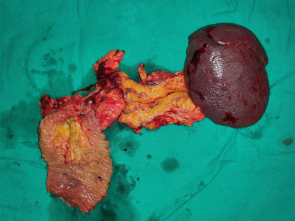 Preparation of vascular branches and excision of mesopancreas (Courtesy Dr. V. Penopoulos)