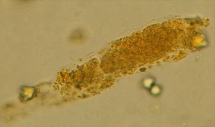 D2 lymphadenectomy . Schematic presentation (Courtesy Dr. V. Penopoulos)