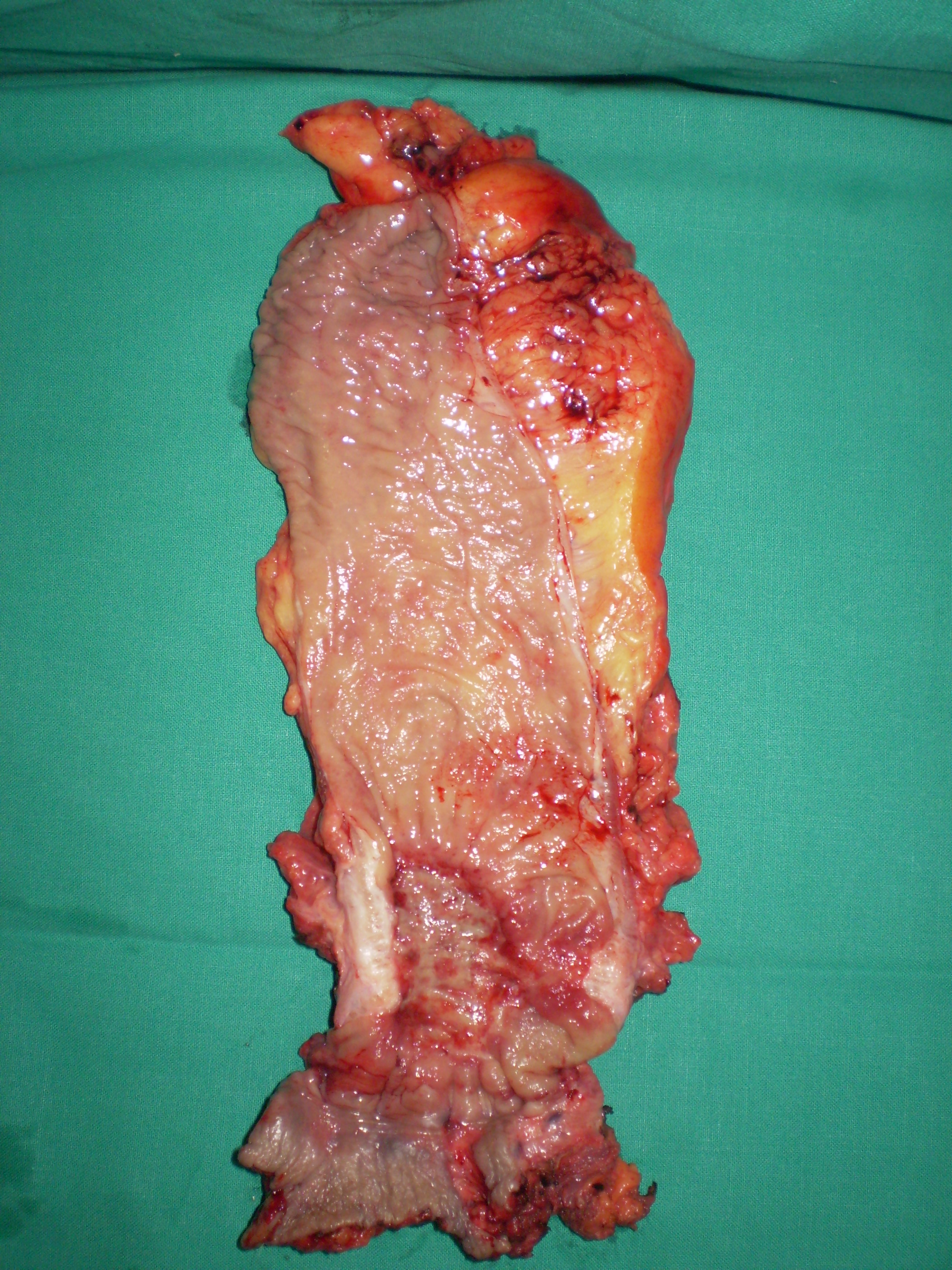 Abdomino-perineal excision for ultra low rectal carcinoma (Courtesy Dr. V. Penopoulos)