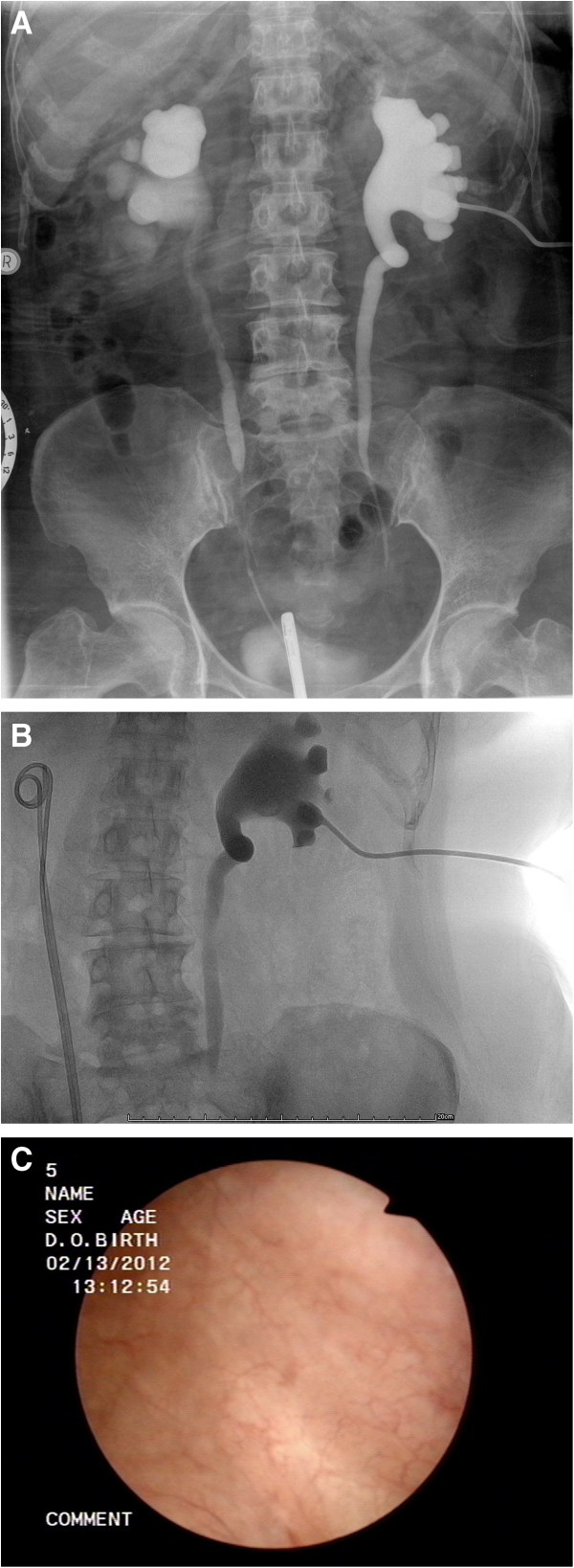 Post radiotherapy treatment I . V . Pyelography . Bilateral Ureteral Stenosis and Hydronephrosis (Courtesy Dr. V. Penopoulos)