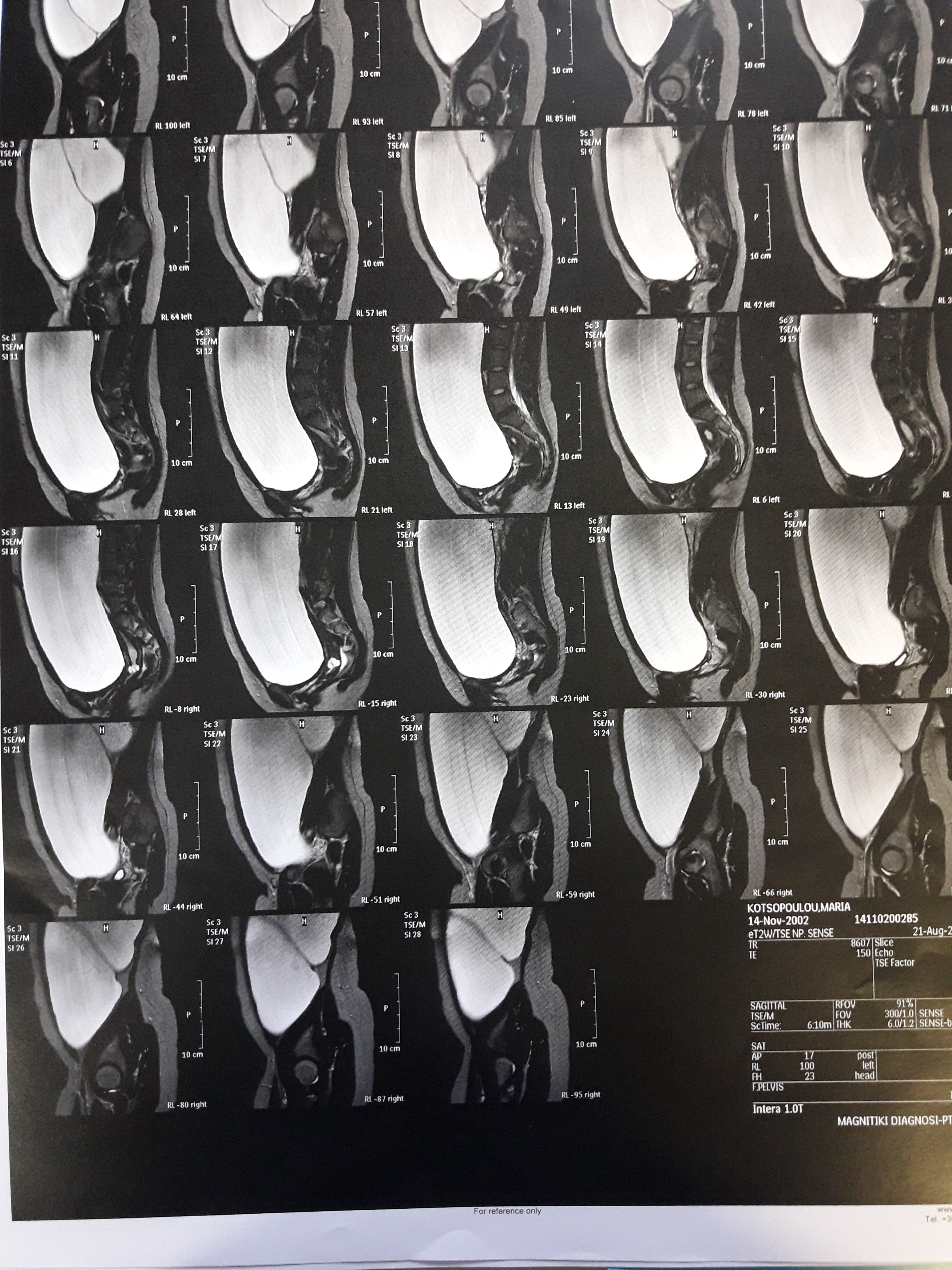 Largely distended abdomen thought to be secondary to dysmenorrhea is evident (Courtesy Dr. V. Penopoulos)