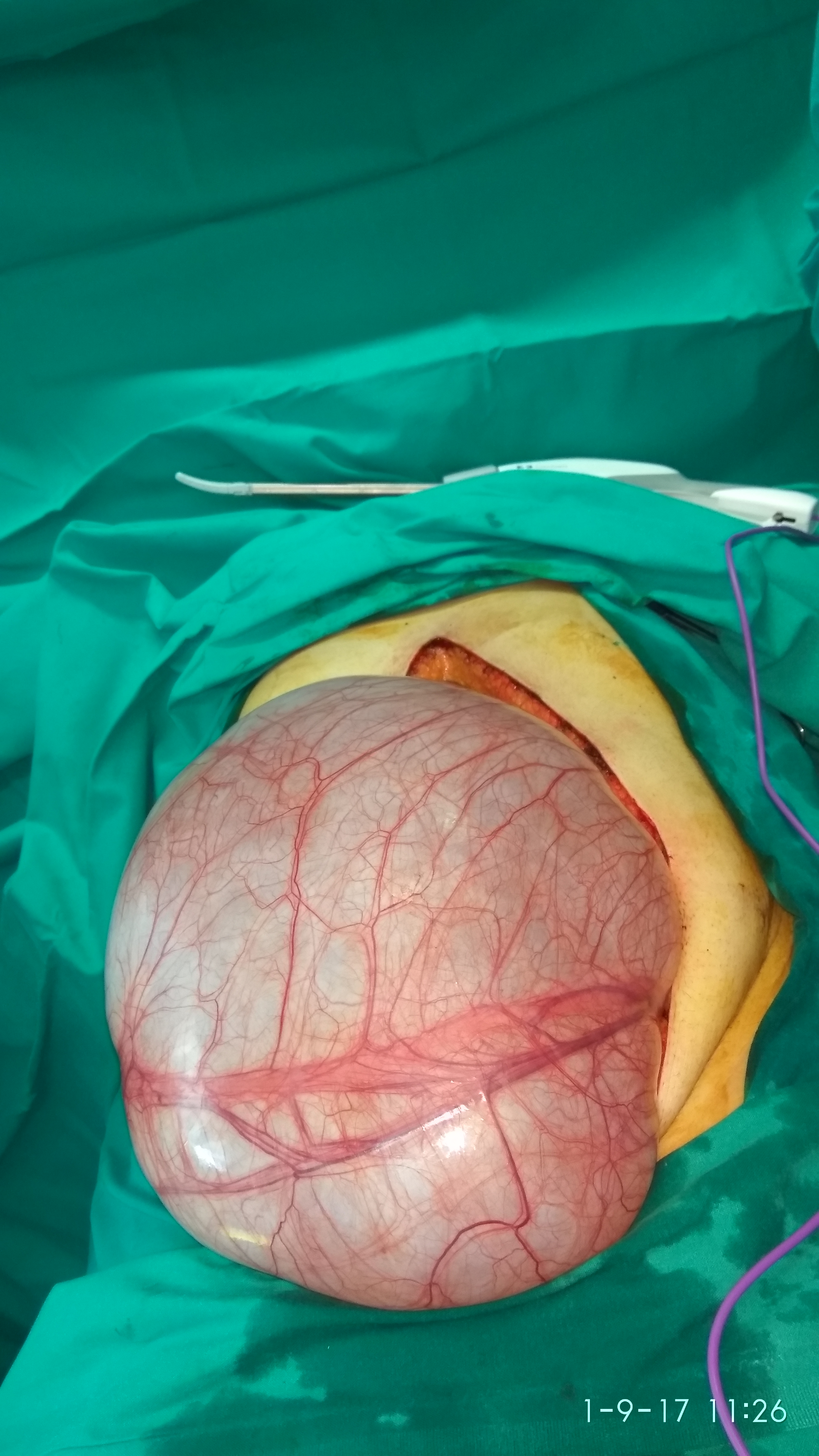 The Huge Ovarian Cystadenomas delivered from the abdominal cavity (Courtesy Dr. V. Penopoulos)