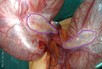 Purple drawing Polycystic Ovaries (Courtesy Dr. V. Penopoulos)