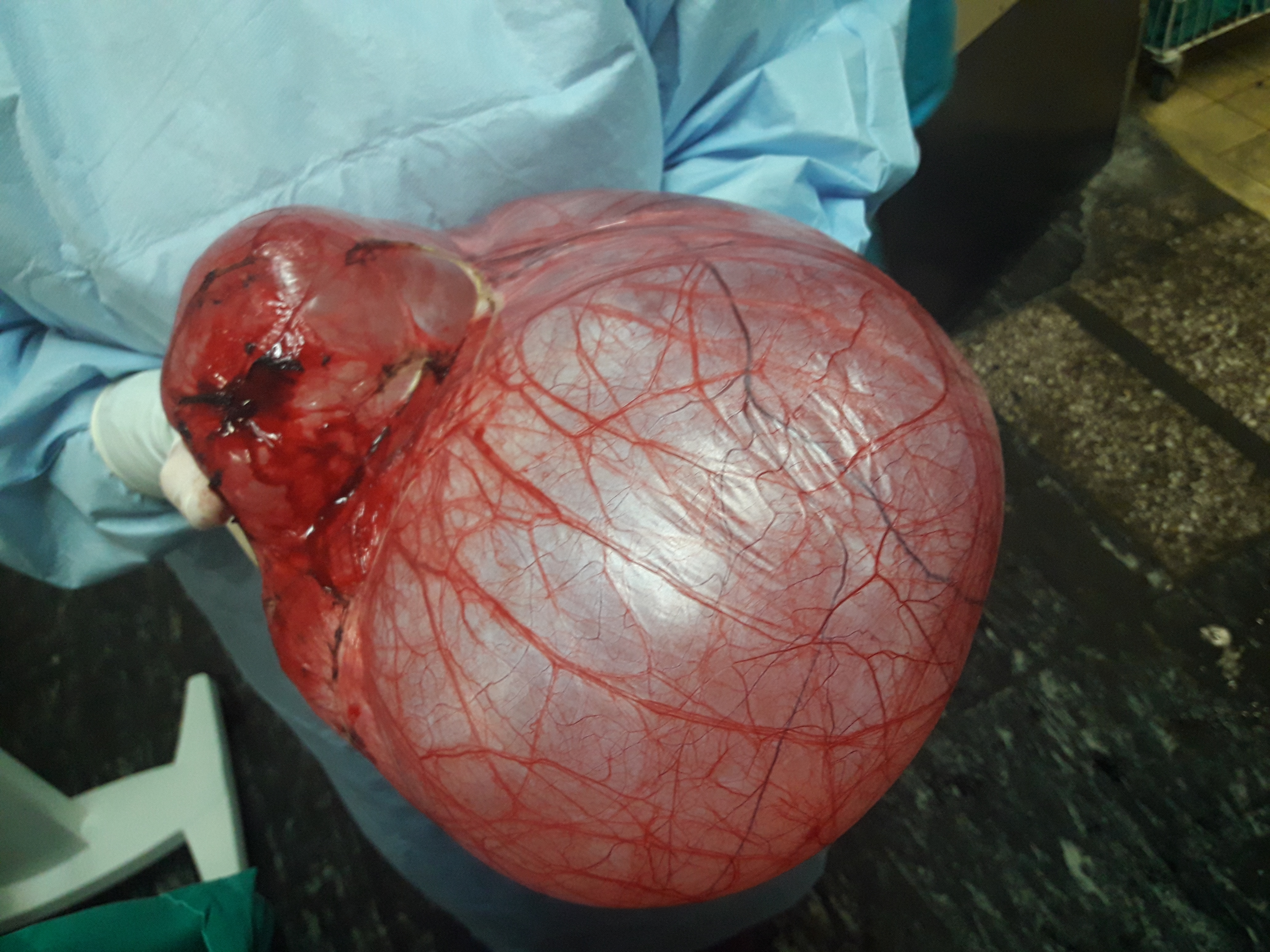 Both cystadenomas were excised with preservation of both ovaries (Courtesy Dr. V. Penopoulos)