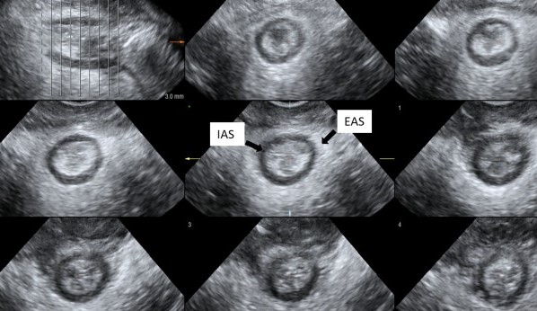 Διάρρηξη εξωτερικού σφιγκτήρα (Ευγενική παραχώρηση Dr. V. Penopoulos)