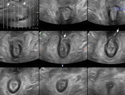 Καμπύλη εγκάρσια τομή (Ευγενική παραχώρηση Dr. V. Penopoulos)
